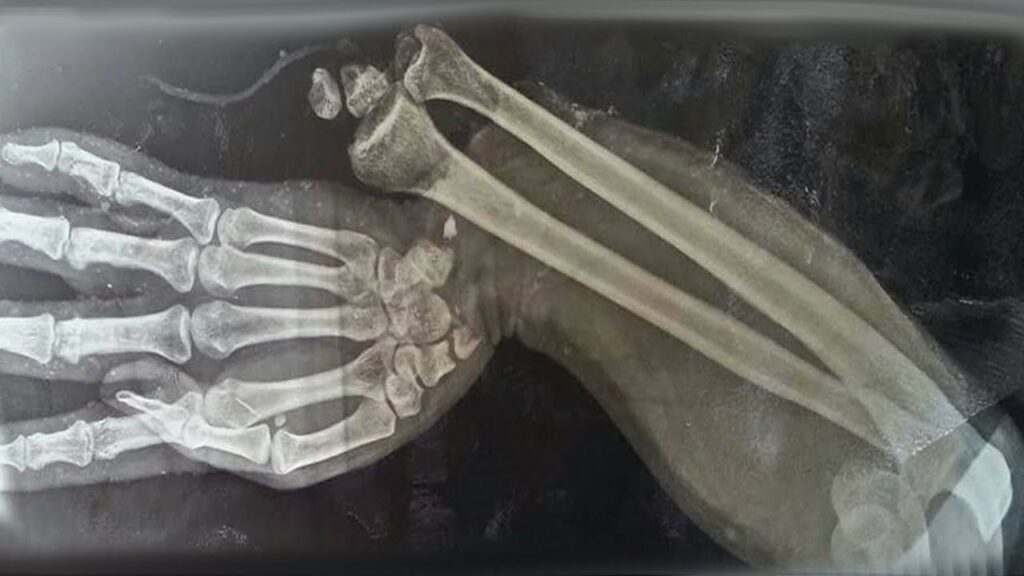A Boy Ate 150 Gummy Vitamins For Breakfast. This Is What Happened To His Bones.
