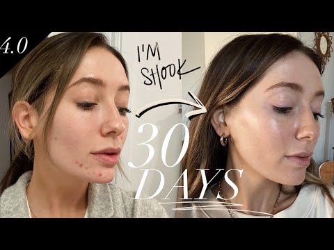 How I cleared my hormonal acne in 30 days | Supplements I take!
